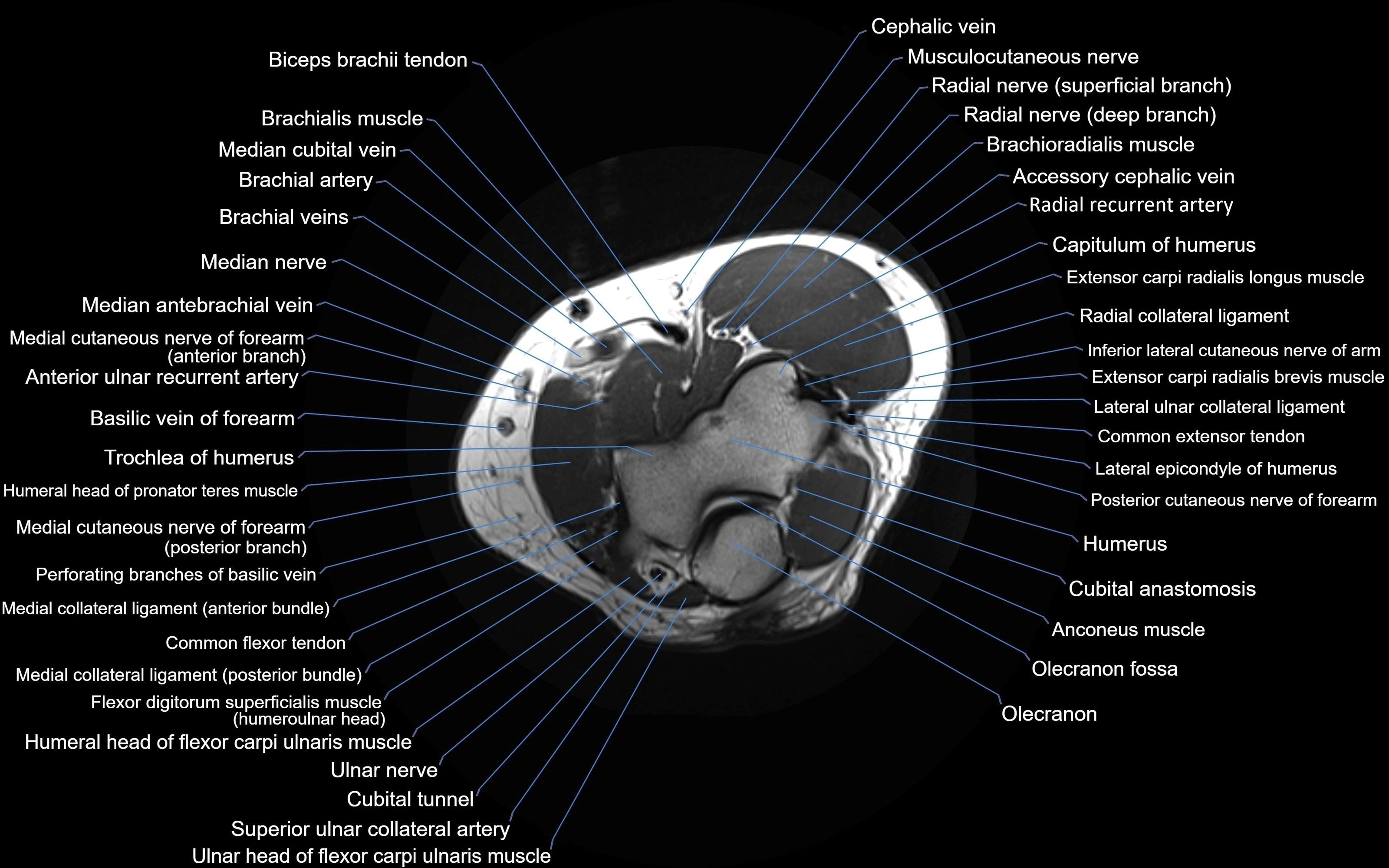 MRI elbow axial cross sectional anatomy 3T  radiology  image-img-00001-00014.webp